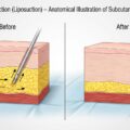 liposuction Gold Coast